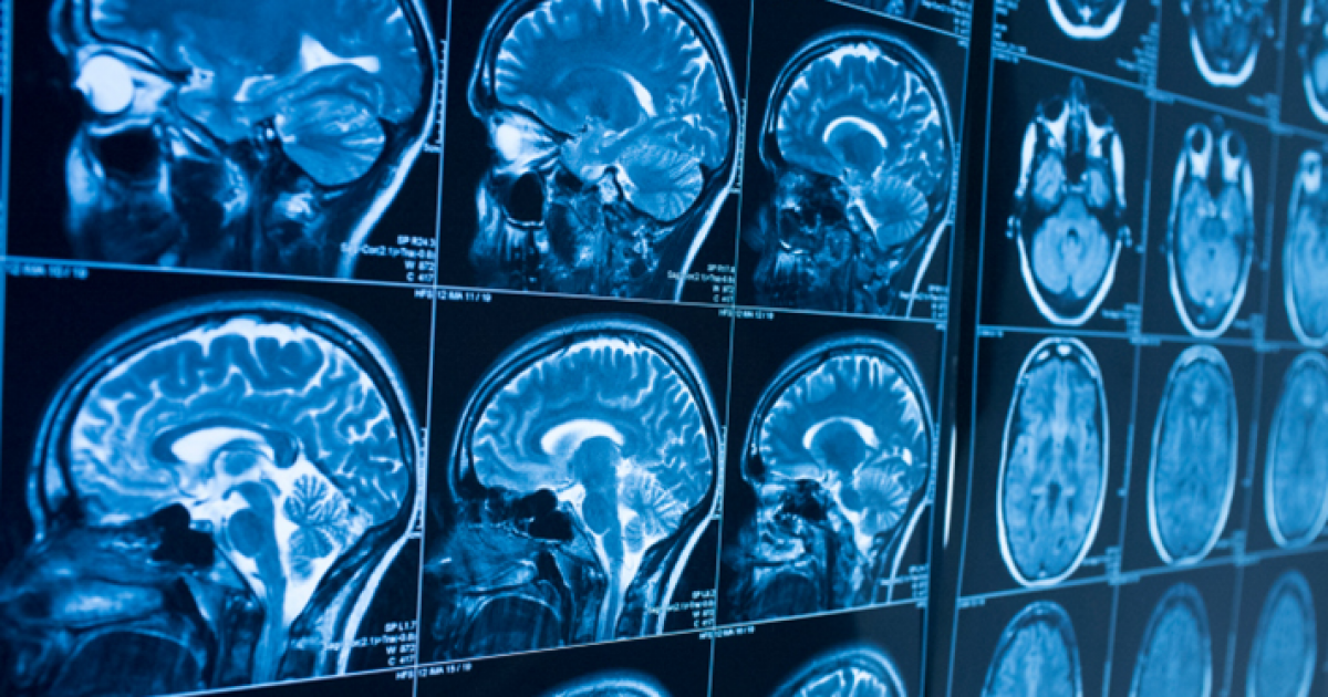 Advanced Neurological Imaging - Huntington Headache
